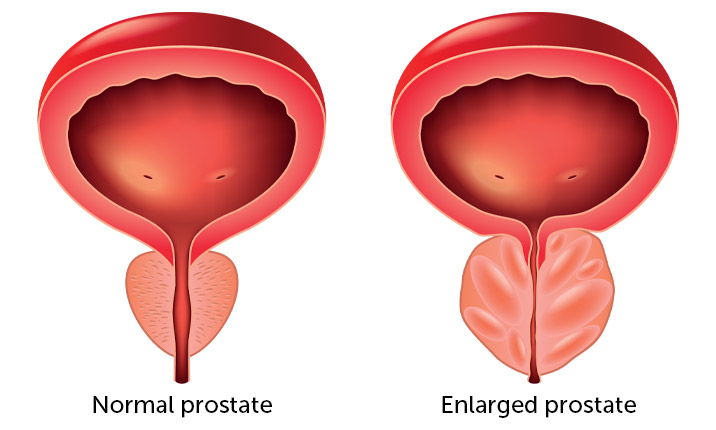 Enlarged prostate